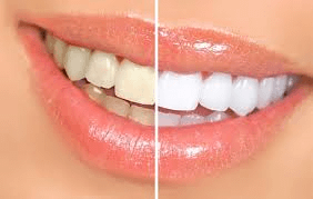 before & after teeth whitening