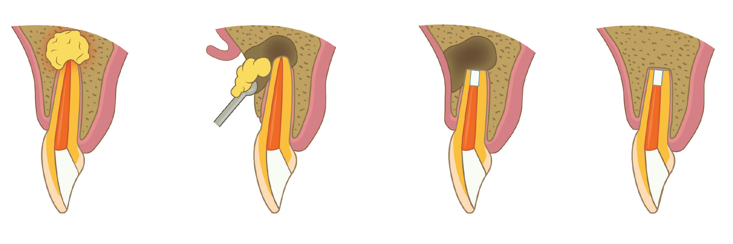 Diagram showing infection at a root tip, surgical cleaning, removal of the root tip and sealing of the root end