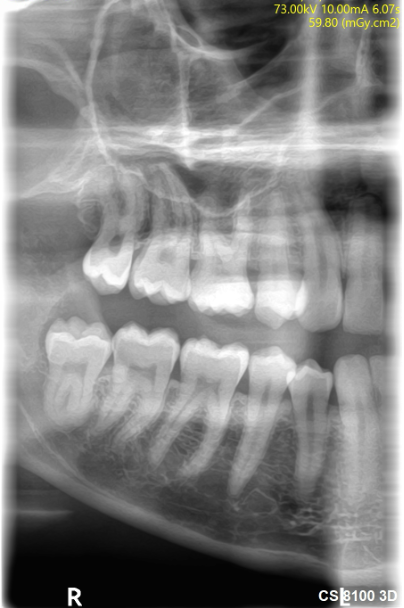 Example extraoral bitewing-style X-ray from the Carestream CS 8100 3D