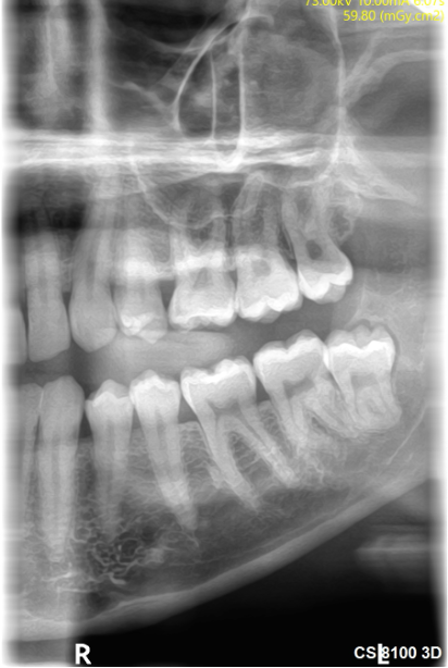 Second example extraoral bitewing-style X-ray from the Carestream CS 8100 3D