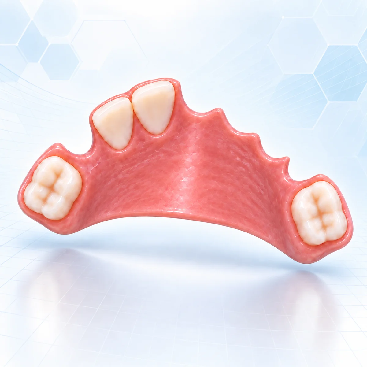 The finished four-tooth upper acrylic partial denture from this case, shown separately with two anterior and two posterior replacement teeth, a broad pink palatal plate and rounded spaces for the remaining natural teeth