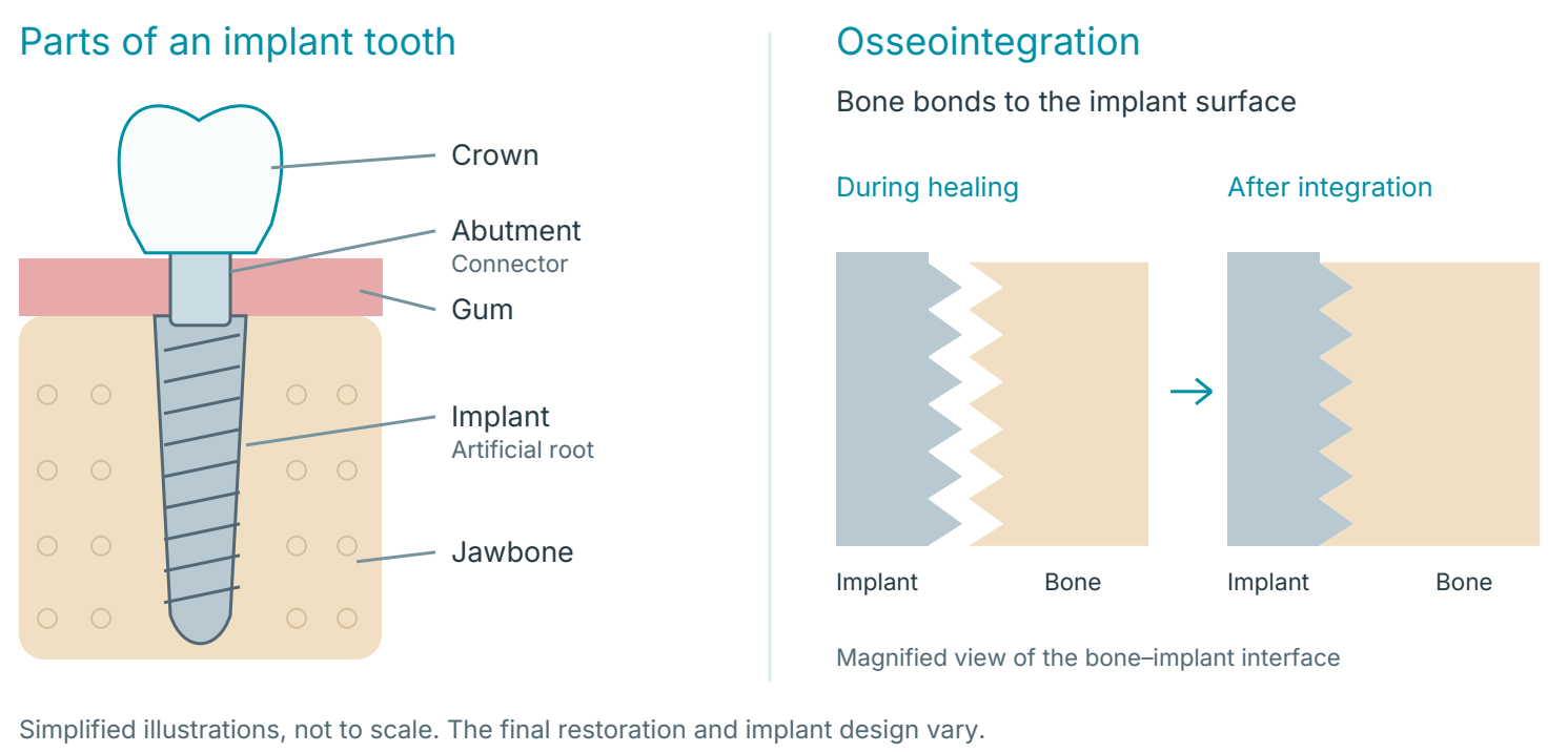 Implant diagrams: the crown connects to the implant through an abutment above the gum, with the implant in the jawbone; during healing, bone bonds closely to the implant surface.