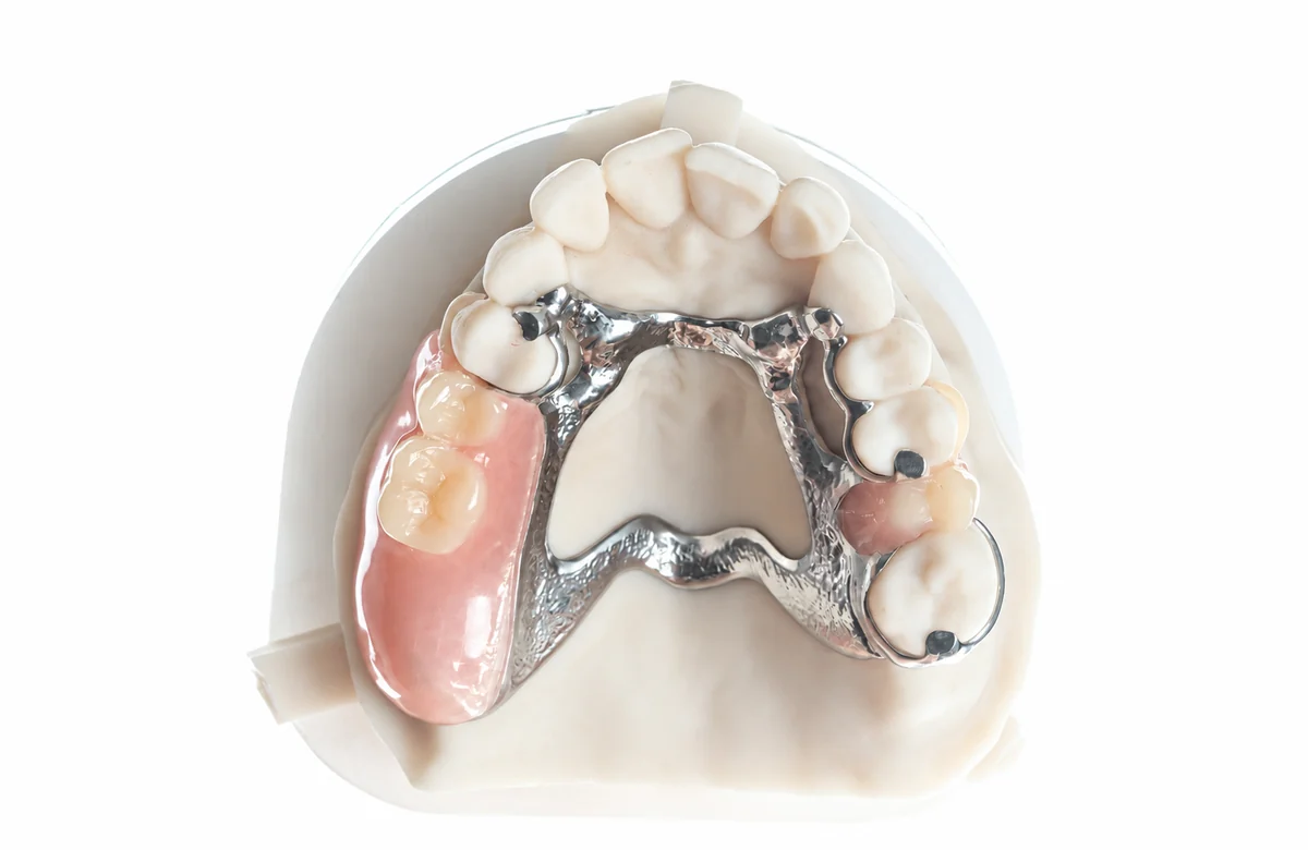 Real fully digital cobalt-chrome partial denture on an upper dental model, shown from above