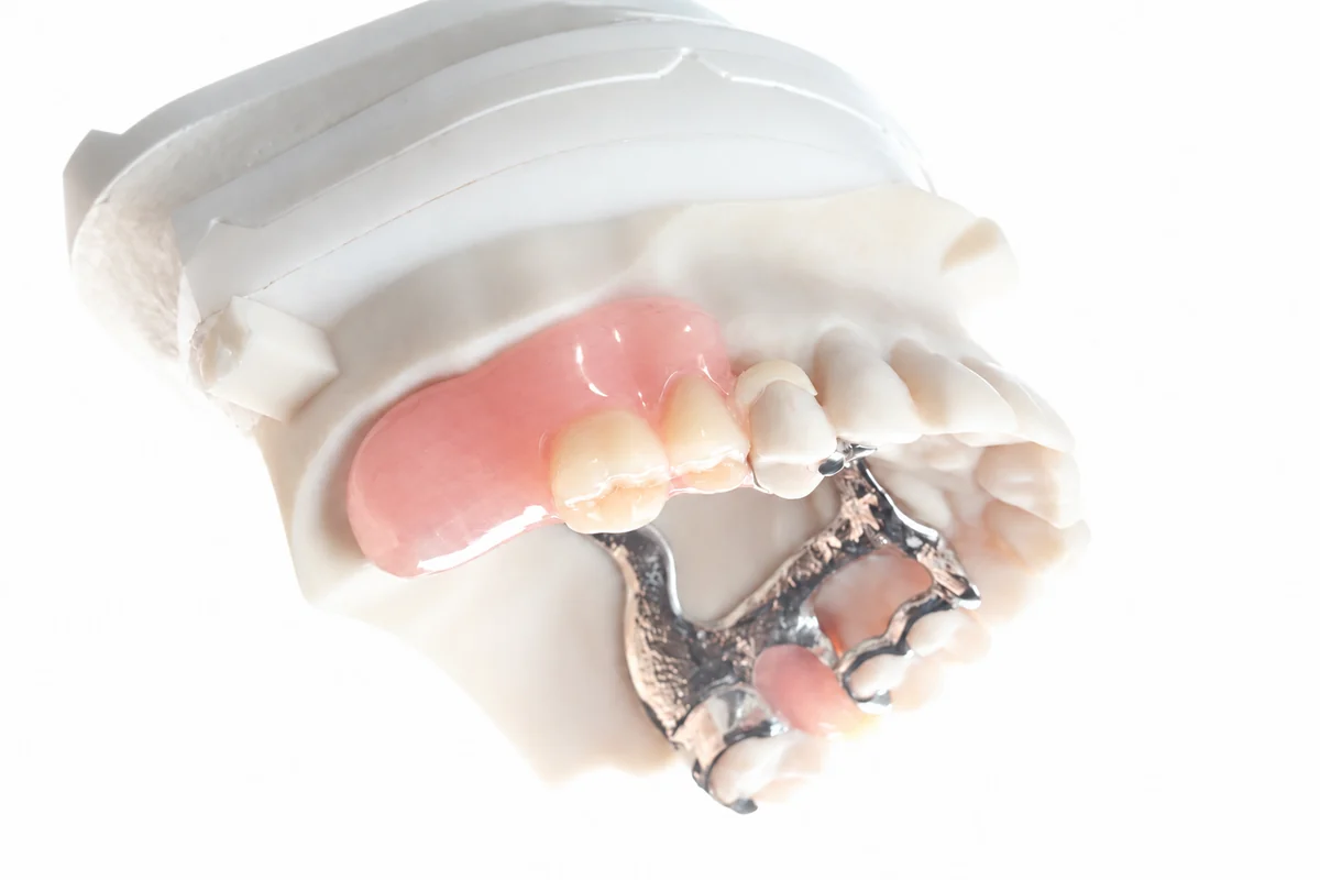 Angled view of the real digital partial denture and its tooth-coloured clasp