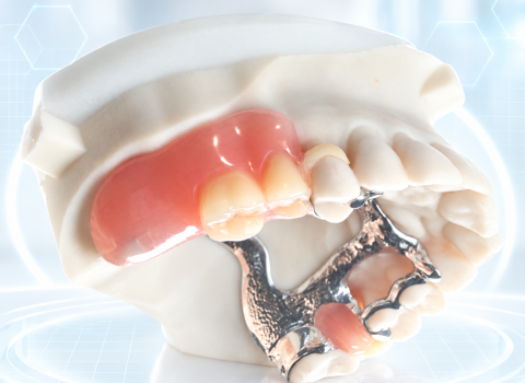 High-technology view of a digitally planned cobalt-chrome partial denture
